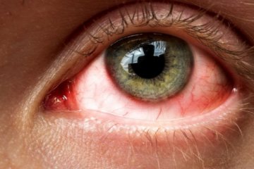 Diabéteszes retinopátia