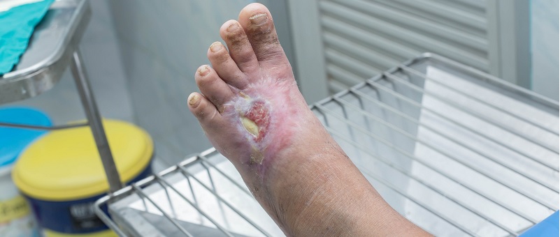 Cukorbeteg láb: hogyan gyógyulnak be a sebek? - Sebkezelégyongyosmezes.hu
