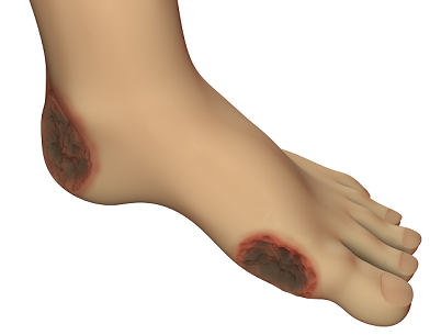 sebek a lábát a cukorbetegség kezelésében