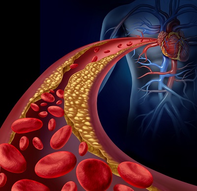 atherosclerosis az alsó végtagok a cukorbetegség kezelésére)