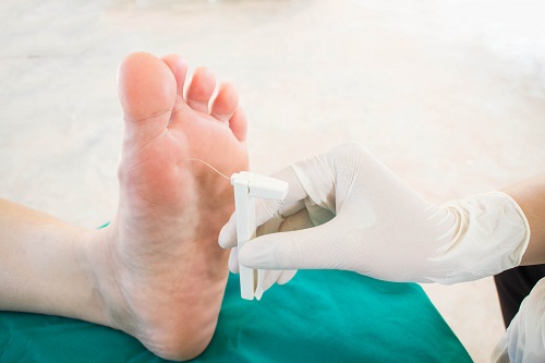Gangrén lábak fotó kezdeti szakaszában diabétesz kezelés - ergofer.hu